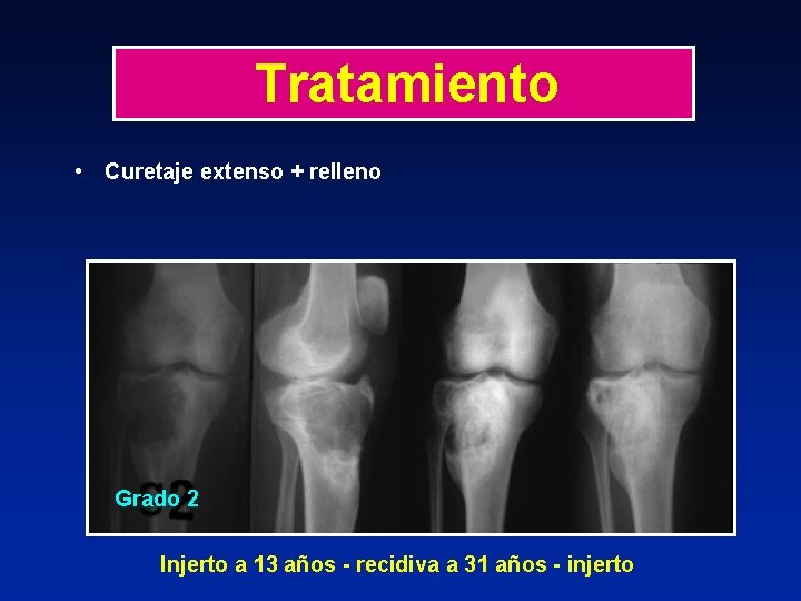 Tratamiento • Curetaje extenso + relleno Grado 2 Injerto a 13 años - recidiva