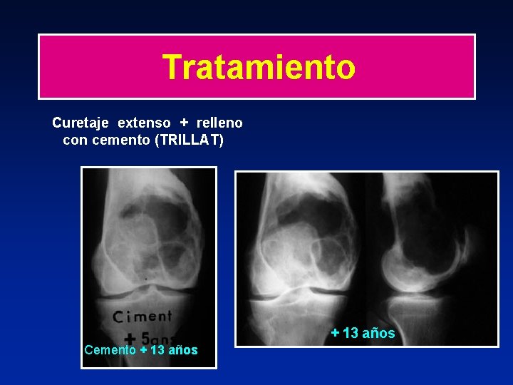 Tratamiento Curetaje extenso + relleno con cemento (TRILLAT) + 13 años Cemento + 13