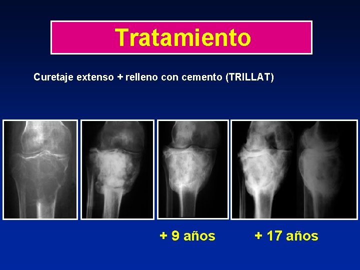 Tratamiento Curetaje extenso + relleno con cemento (TRILLAT) + 9 años + 17 años