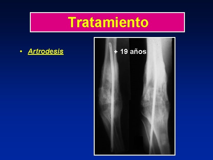 Tratamiento • Artrodesis + 19 años 