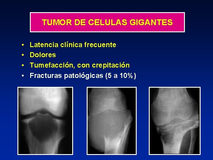 TUMOR DE CELULAS GIGANTES • • Latencia clínica frecuente Dolores Tumefacción, con crepitación Fracturas