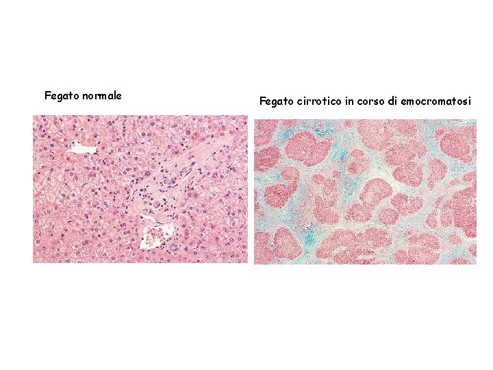 Fegato normale Fegato cirrotico in corso di emocromatosi 