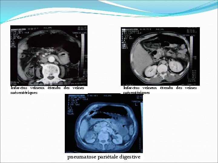 Infarctus veineux étendu des veines mésentériques pneumatose pariétale digestive 