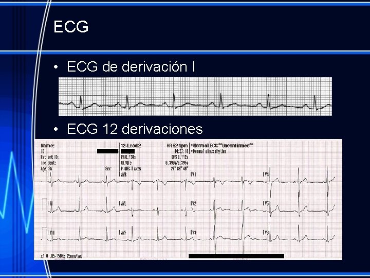 ECG • ECG de derivación I • ECG 12 derivaciones 