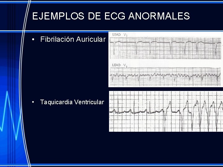 EJEMPLOS DE ECG ANORMALES • Fibrilación Auricular • Taquicardia Ventricular 