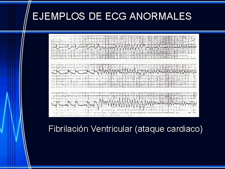 EJEMPLOS DE ECG ANORMALES Fibrilación Ventricular (ataque cardiaco) 
