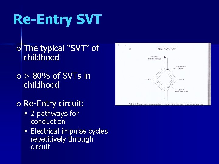 Re-Entry SVT The typical “SVT” of childhood > 80% of SVTs in childhood Re-Entry