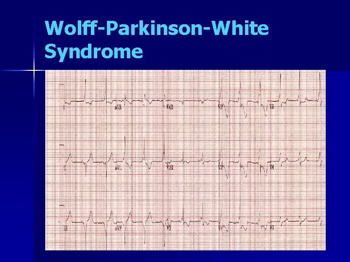 Wolff-Parkinson-White Syndrome 