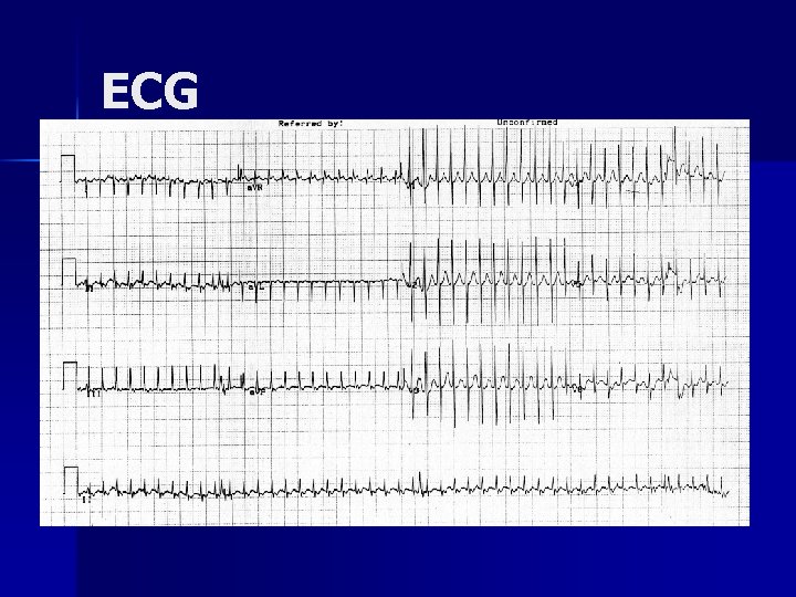 ECG 