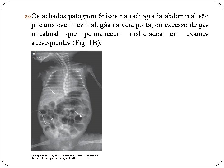  Os achados patognomônicos na radiografia abdominal são pneumatose intestinal, gás na veia porta,