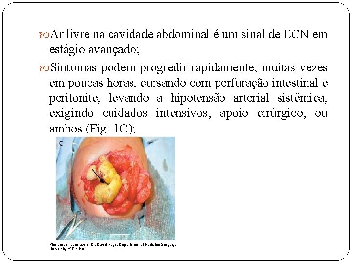  Ar livre na cavidade abdominal é um sinal de ECN em estágio avançado;