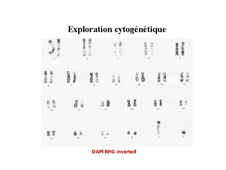 Exploration cytogénétique DAPI RHG inverted 