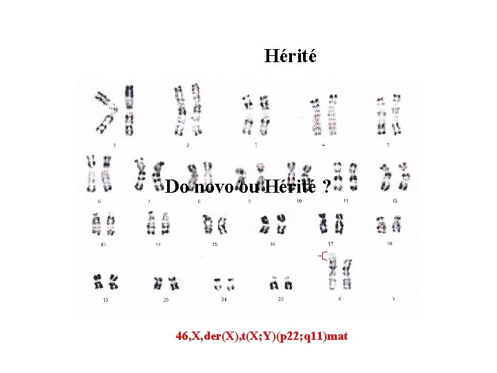 Hérité Do novo ou Hérité ? 46, X, der(X), t(X; Y)(p 22; q 11)mat