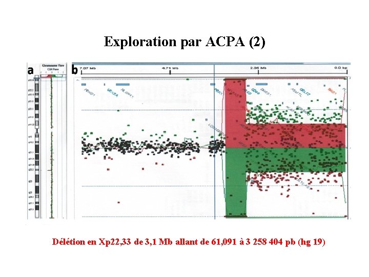 Exploration par ACPA (2) Délétion en Xp 22, 33 de 3, 1 Mb allant