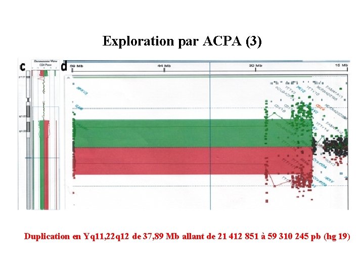 Exploration par ACPA (3) Duplication en Yq 11, 22 q 12 de 37, 89