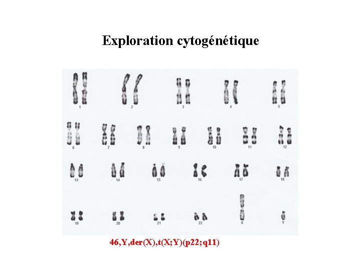 Exploration cytogénétique 46, Y, der(X), t(X; Y)(p 22; q 11) 