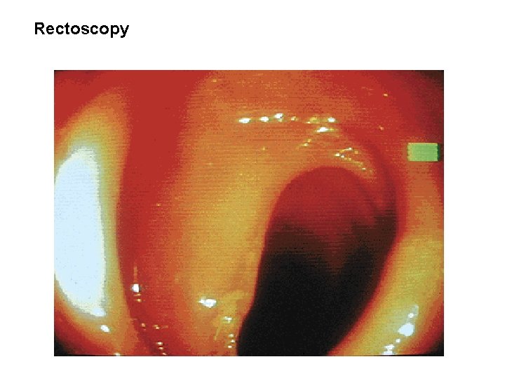 Rectoscopy 