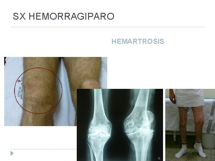 SX HEMORRAGIPARO HEMARTROSIS 