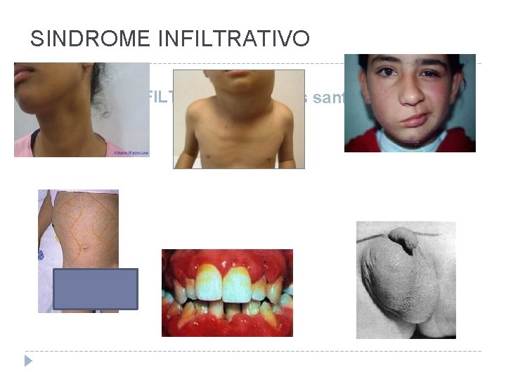 SINDROME INFILTRATIVO Sitios santuarios 