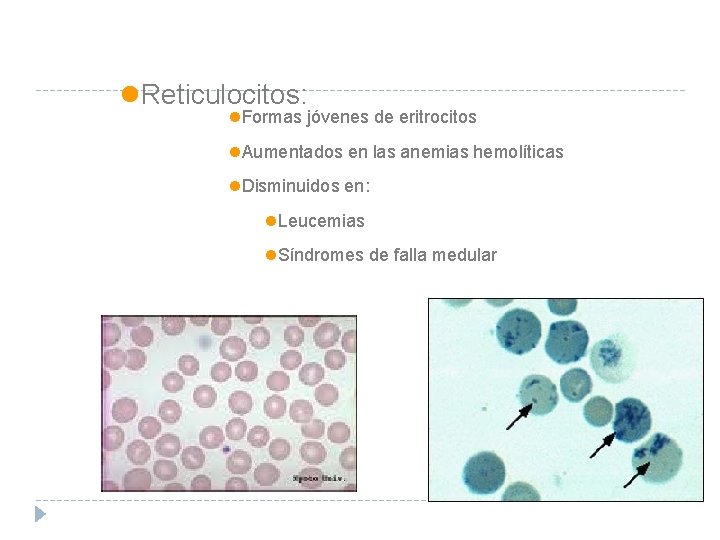 l. Reticulocitos: l. Formas jóvenes de eritrocitos l. Aumentados en las anemias hemolíticas l.