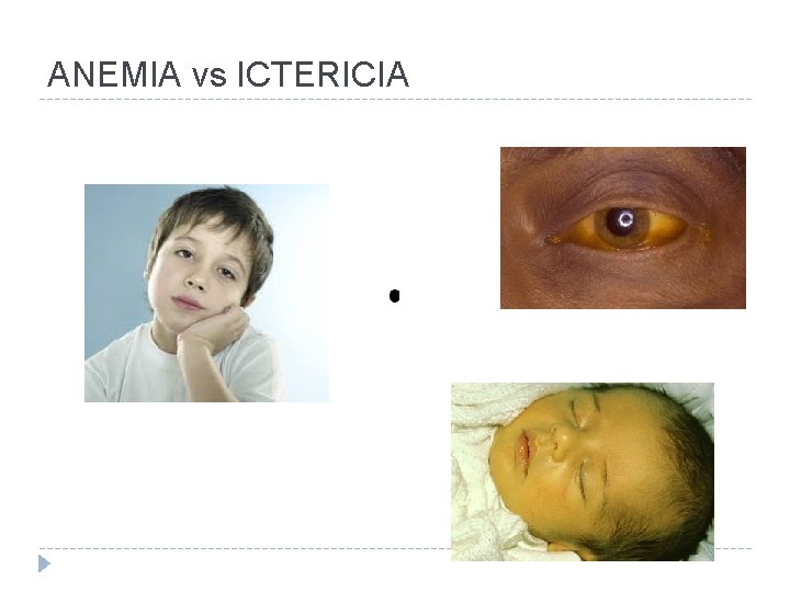 ANEMIA vs ICTERICIA 