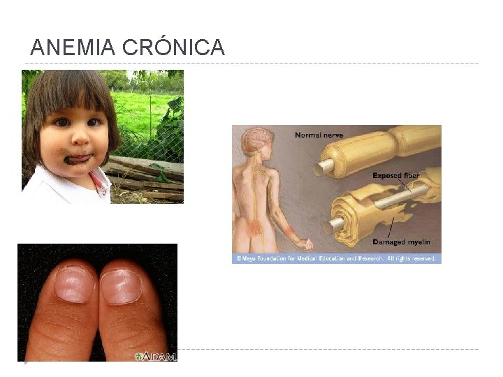 ANEMIA CRÓNICA 