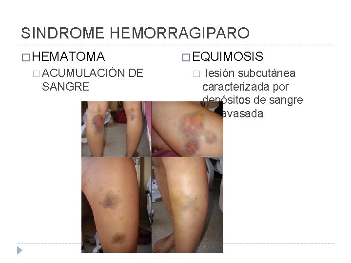 SINDROME HEMORRAGIPARO � EQUIMOSIS � HEMATOMA � ACUMULACIÓN SANGRE DE � lesión subcutánea caracterizada