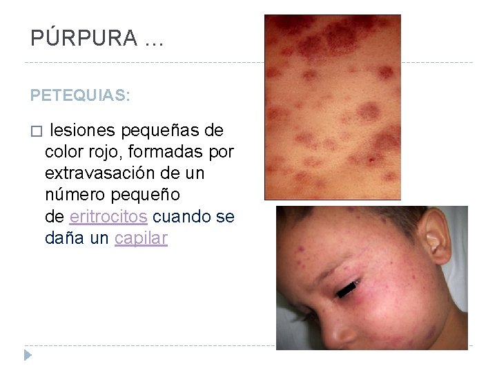 PÚRPURA … PETEQUIAS: � lesiones pequeñas de color rojo, formadas por extravasación de un