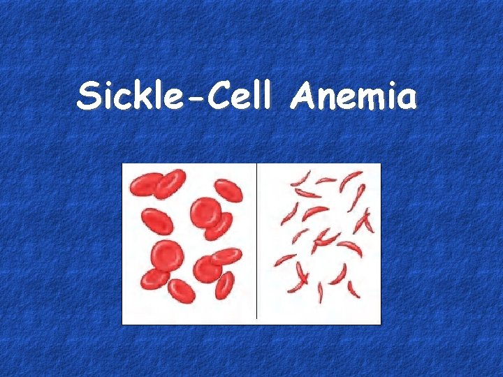 Sickle-Cell Anemia 