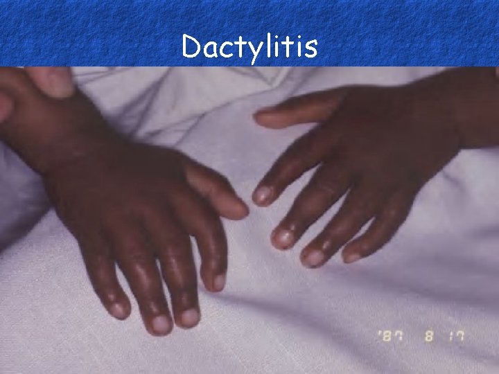 Dactylitis 