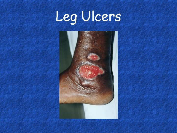 Leg Ulcers 