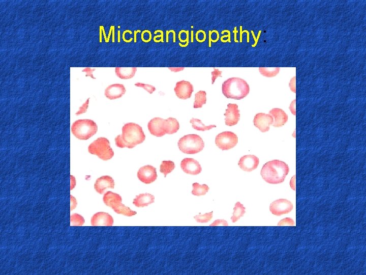 Microangiopathy: 