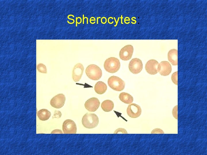 Spherocytes: 