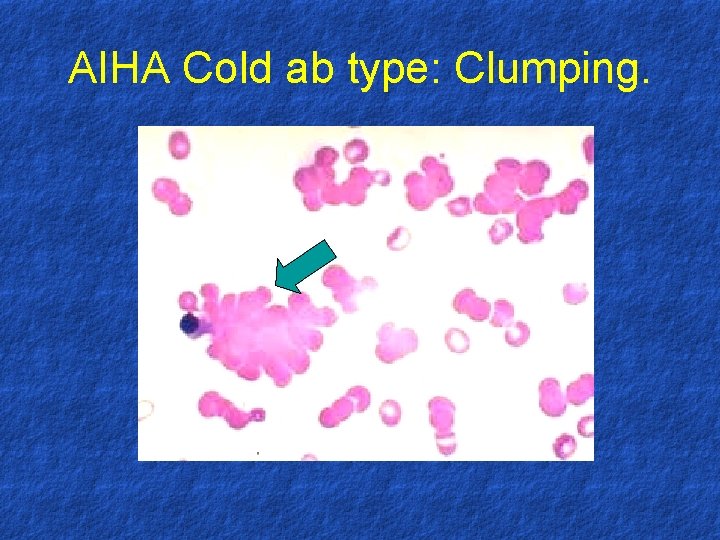 AIHA Cold ab type: Clumping. 