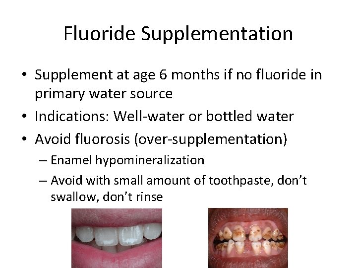 Fluoride Supplementation • Supplement at age 6 months if no fluoride in primary water