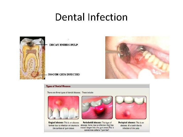 Dental Infection 