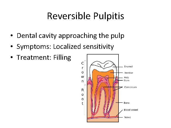 Reversible Pulpitis • Dental cavity approaching the pulp • Symptoms: Localized sensitivity • Treatment: