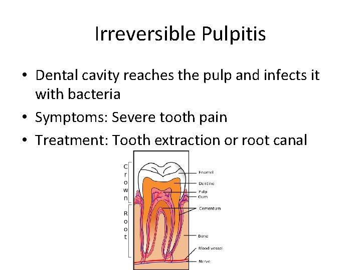 Irreversible Pulpitis • Dental cavity reaches the pulp and infects it with bacteria •