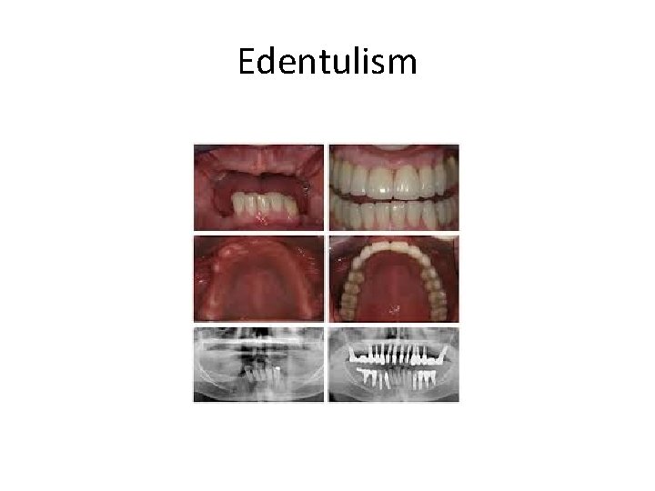 Edentulism 