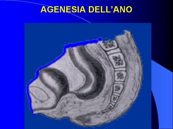 AGENESIA DELL’ANO 