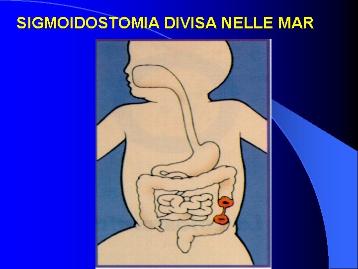 SIGMOIDOSTOMIA DIVISA NELLE MAR 