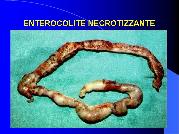 ENTEROCOLITE NECROTIZZANTE 