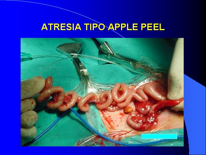 ATRESIA TIPO APPLE PEEL 