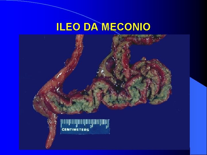 ILEO DA MECONIO 