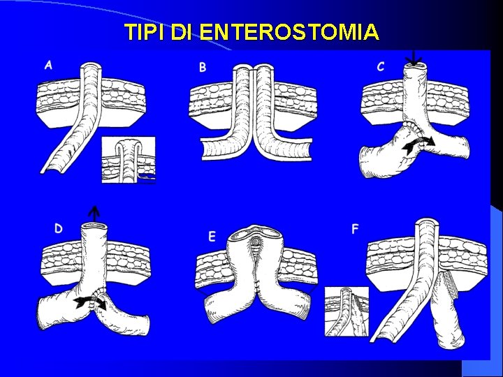 TIPI DI ENTEROSTOMIA 