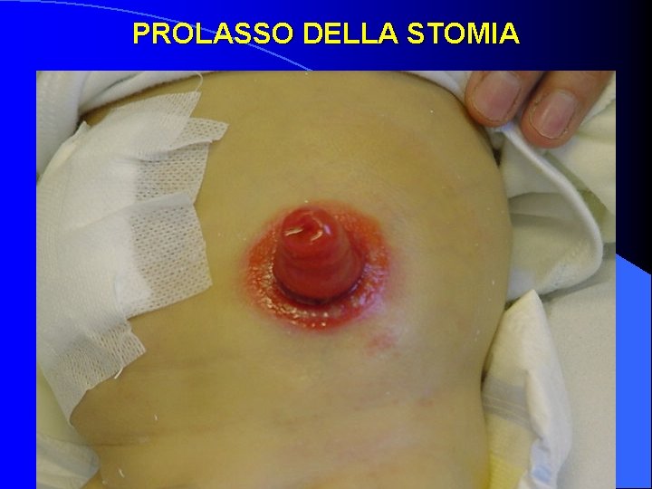 PROLASSO DELLA STOMIA 