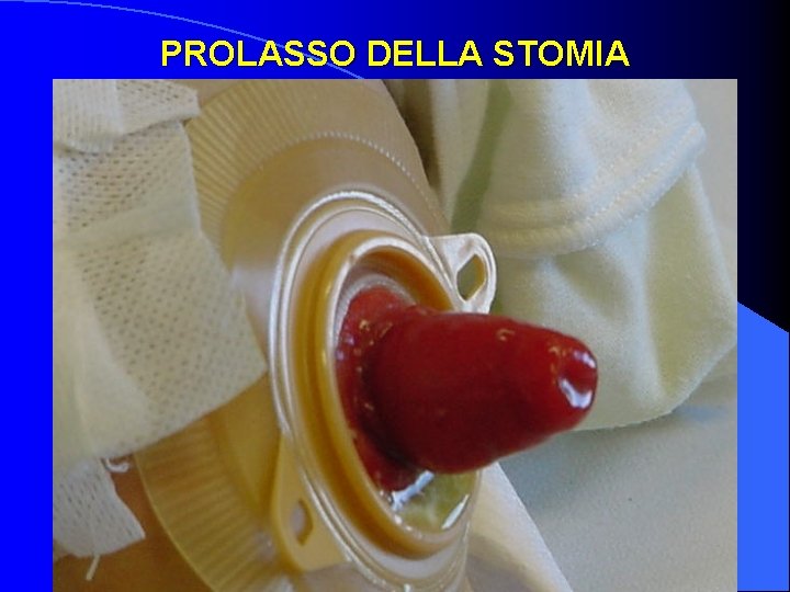 PROLASSO DELLA STOMIA 