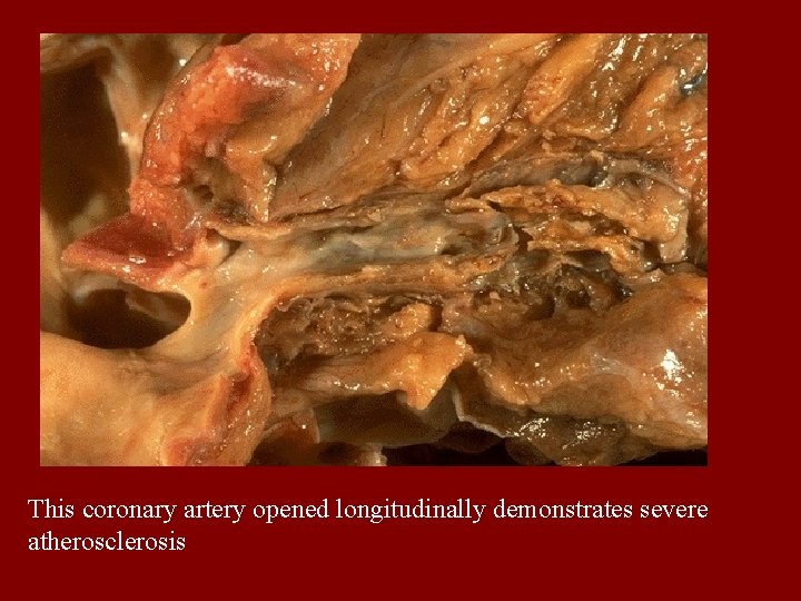 This coronary artery opened longitudinally demonstrates severe atherosclerosis 