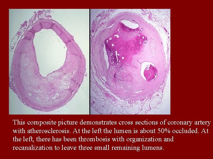 This composite picture demonstrates cross sections of coronary artery with atherosclerosis. At the left
