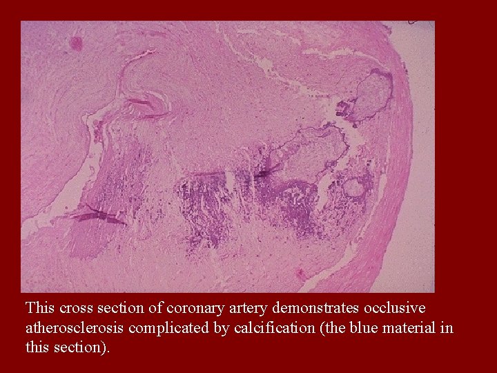 This cross section of coronary artery demonstrates occlusive atherosclerosis complicated by calcification (the blue